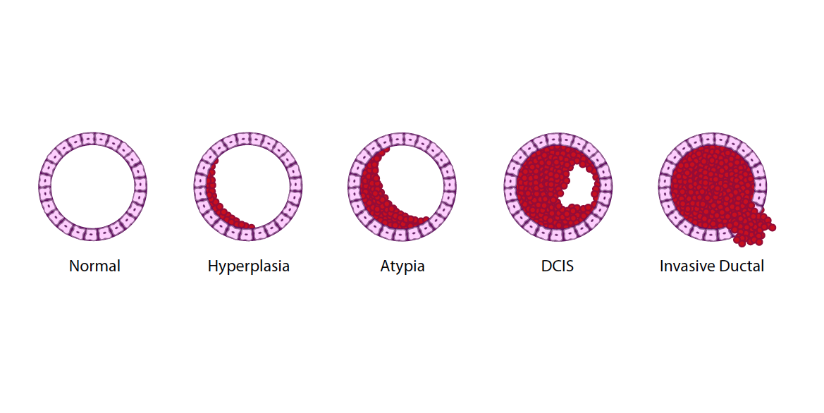 What are the success rates for invasive ductal carcinoma treatments?