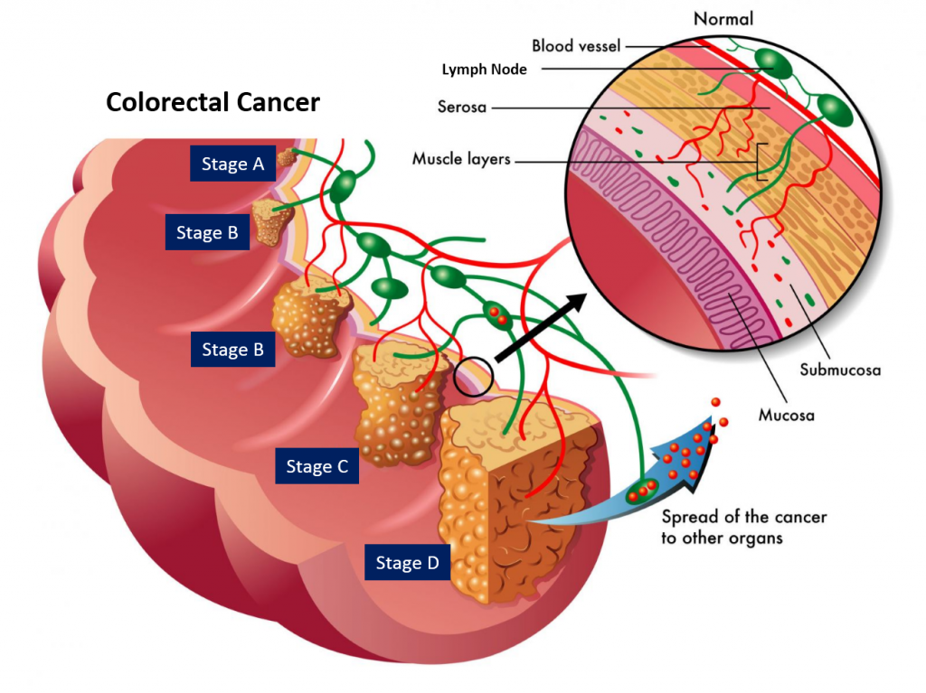 Newsroom Biomarker Discovery Offers Clearer Prognosis For Bowel And 